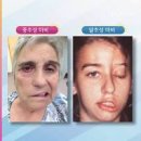 뇌졸중 전조 뇌졸중 초기 이미지