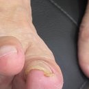 레푸스인하대역점 내성발톱 무좀발톱 발각질 문제성발 | 인천내성발톱 레푸스 인하대역점 내성발톱 무좀발톱 발각질 문제성발을 추천합니다