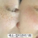 솔라플랜 | [거제피부관리] 짙어진 색소 잡티 고민? 거제솔라뷰티 1:1 맞춤 플라즈마 케어 후기