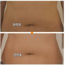 압구정허치벨 웨딩관리 다이어트 웨딩촬영 후기