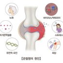 류마티스 관절염 (Rheumatoid Arthritis) 이미지