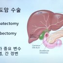 담도암의 수술 부위는 3개 영역으로 구분이 됩니다 이미지