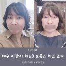 오도도 마우스피스 | 대구 이갈이 치료) 턱관절 장애로 보톡스 치료 내돈내산 후기(ft. 이갈이 효과/브이라인 효과)