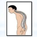 세움보조기 | 척추결핵(spinal caries) 이란?