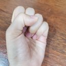 손가락 골절 수술 후기 (5) 깁스 풀고 난 후 각질 관리, 도수 치료, 손가락 붓기, 실생활 재활 과정 공유