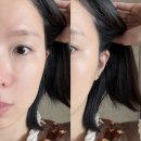디자인봄VOM | 강남역피부과 귀필러 맞고온 대만족 후기!