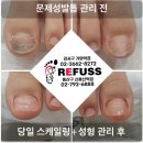 레푸스 네이버블로그