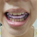 프리웨이스토어 | 팔자주름없애기 , 팔자주름없애는법 아우라오라 마우스피스 후기