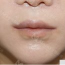 재건상회 | 윗입술확대 수술 후기 확인하고 결정하세요