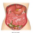 장폐색 원인 증상 치료방법 마비성장폐색증 배가 아플때 이미지