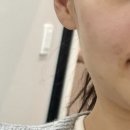 수도의원 | [공지] [강동 고덕 슬로아의원] 찐 리얼 후기 /관리 전후 비교 사진