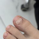 부평역(대한극장)(40196) | 초등학생 내성발톱 교정 후기 /부평내성발톱 레푸스 부평역점