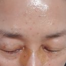 리지엔피부과의원 | 얼굴 쥐젖? 제거로 행복 충전... 분당 리지엔피부과에서~~!!^^