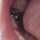 청사치과의원 | 내포아이랑소아치과의원 신경치료