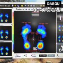 대구제일보조기·의수족 | 대구 수성구 맞춤깔창 잘하는곳 레알포디바이오메카닉스 (+족저근막염, 평발, X자다리 등)