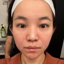 강피부과의원 | 구월동 피부과ㅣ올타이트리프팅 600샷 팔자주름 효과