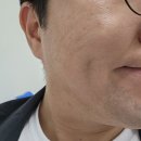 수염레이저제모 15회 리얼후기 이거 하나로 정리다해줌(2) 내돈내산