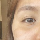 개월 | 오타모반 치료 완료 + n개월 후기