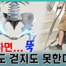 고관절 골절 수술에 관한 영상 이미지