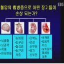 고혈압 합병증 바로알기 시리즈1 이미지