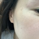 라디앙의원 | [구리 인창동]출산후 기미주근깨 피코토닝 꼼꼼한 라디앙(첫만남이용권사용)