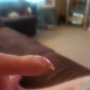 폐암을 진단 할 수 있는 간단한 손가락 트릭(finger trick) 이미지
