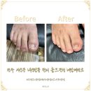 홀드핀칭 | 전주 서신동 내성발톱 무좀 관리 홀드핀칭 네일제작소 솔직후기