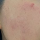 하라라성형외과의원 | 부산 하단 홍조(혈관)치료 피부과 추천/엑셀V 시술 후기