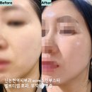 오랑개 | 신논현피부과 스킨부스터 셀르디엠 ecm스킨부스터 탱탱 모공 피부결에 즉각 효과봤어요 리투오랑 차이