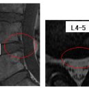 다린 님의 흉추디스크 T11-12, 요추디스크 L4-5 MRI 사진 판독입니다. 이미지
