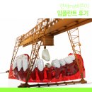 바른이치과기공소 | 마포 임플란트 후기 자꾸 보고 싶어!