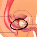 전립선암 의 최근 치료 동향은 수술, 항암 치료, 방사선 치료의 조합 입니다 ​ 이미지