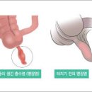맹장염 충수염 원인 초기증상 만성 급성 맹장염 맹장터지는이유 위험성 이미지