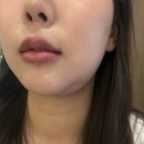 온막천 | 온다리프팅 후기｜[신논현] 내돈내산 온다리프팅 찐후기 ✨ 통증·붓기·효과 before &amp; after