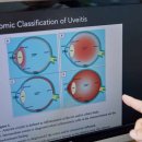 포도막염은 난치·실명질환? 이제는 옛날 얘기 이미지
