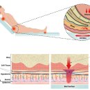 의료법인 명일의료재단 | 꼬리뼈 욕창 왜 유독 이 부위에 잘 생길까? 원인과 예방법