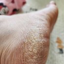 창포찜질방 | 각화형 무좀 연고 사용 후기, 추천 (완치 성공)