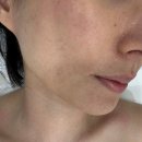 하이필스킨 여의도점 | 여의도 홍조 피부관리 하이필스킨 여의도점 장벽복구프로그램 후기