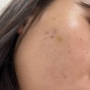 아비쥬의원 | [아비쥬의원 구로]리쥬란 힐러 2cc 내돈내산 후기/고통아픔정도/가격/내돈내산/관리/솔직후기