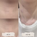자르세 헤어/스킨휴 | 강남역피부과 목주름리프팅(튠아이즈+스킨보톡스) 후기
