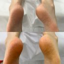아코네일 | 천안 쌍용동 네일아트 아코네일 문제성발톱관리 각질관리 전문