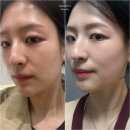 아셀 | 신논현 스킨부스터 유명한 피부과 쥬브아셀 후기!