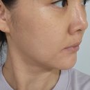 모델로피부과의원 | 강남역피부과 티타늄 리프팅 후기｜팔자주름리프팅 고민에 강남피부과추천 올피채의원 강남점 방문기