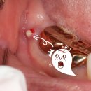 미니스톱 단대병원정문점 | 붓는다면? → 뿌리 균열로 인한 잇몸 염증 &amp; 임플란트 수술 사례 후기 (금광동 치과 단대 오거리 치과)