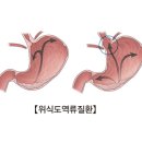 위식도 역류성 질환 (Gastro-esophagus reflux disease) 이미지