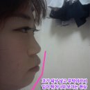 와이앤티 | 와이앤티성형외과에서 페이스오프한 빵끄미님의 후기~!