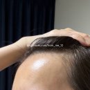 3041 | M자 헤어라인 모발이식 (1년 후기-수술 당일, 3041모 이식)