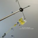 요로결석 고열과 신우신염 증상, 2차 쇄석술 통증 후기 비뇨기과 추천