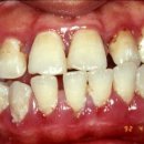 만성 치은염(Chronic gingivitis) ﻿ 이미지