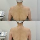 핌케어 | 인천 웨딩케어 핌에스테틱 승모근 관리 후기